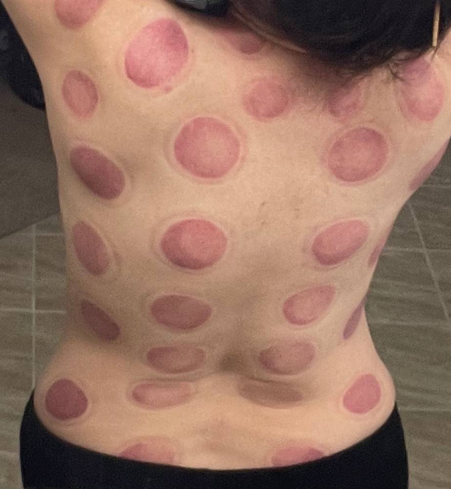 Cupping Therapy Massage 30m