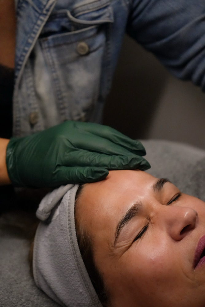 Microneedling Session