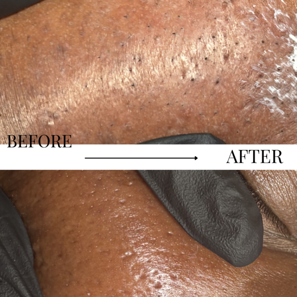 Deep Cleanings/ Acne Prone Facial at LBI. Esthetics in Martinsburg, WV