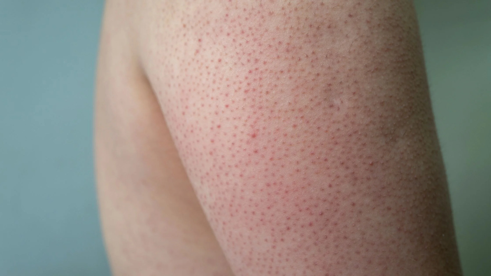 Keratosis Pilaris