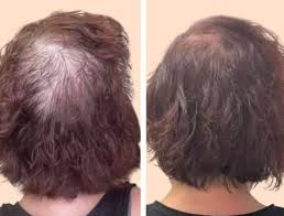 Hair Restoration
