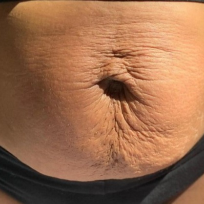 SCAR REMOVAL (LARGE) PKG OF 3 at WilKay Wellness & Aesthetics in Gilbert, AZ