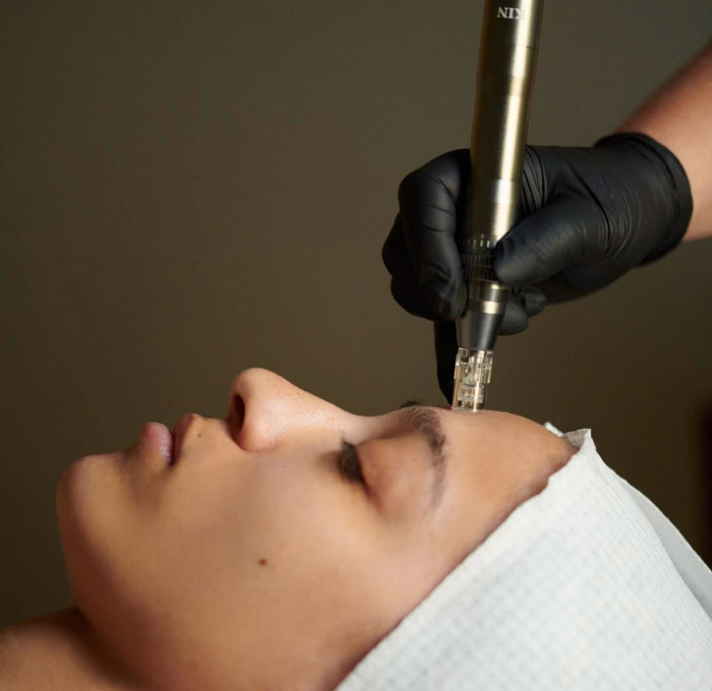 Microneedling Treatment