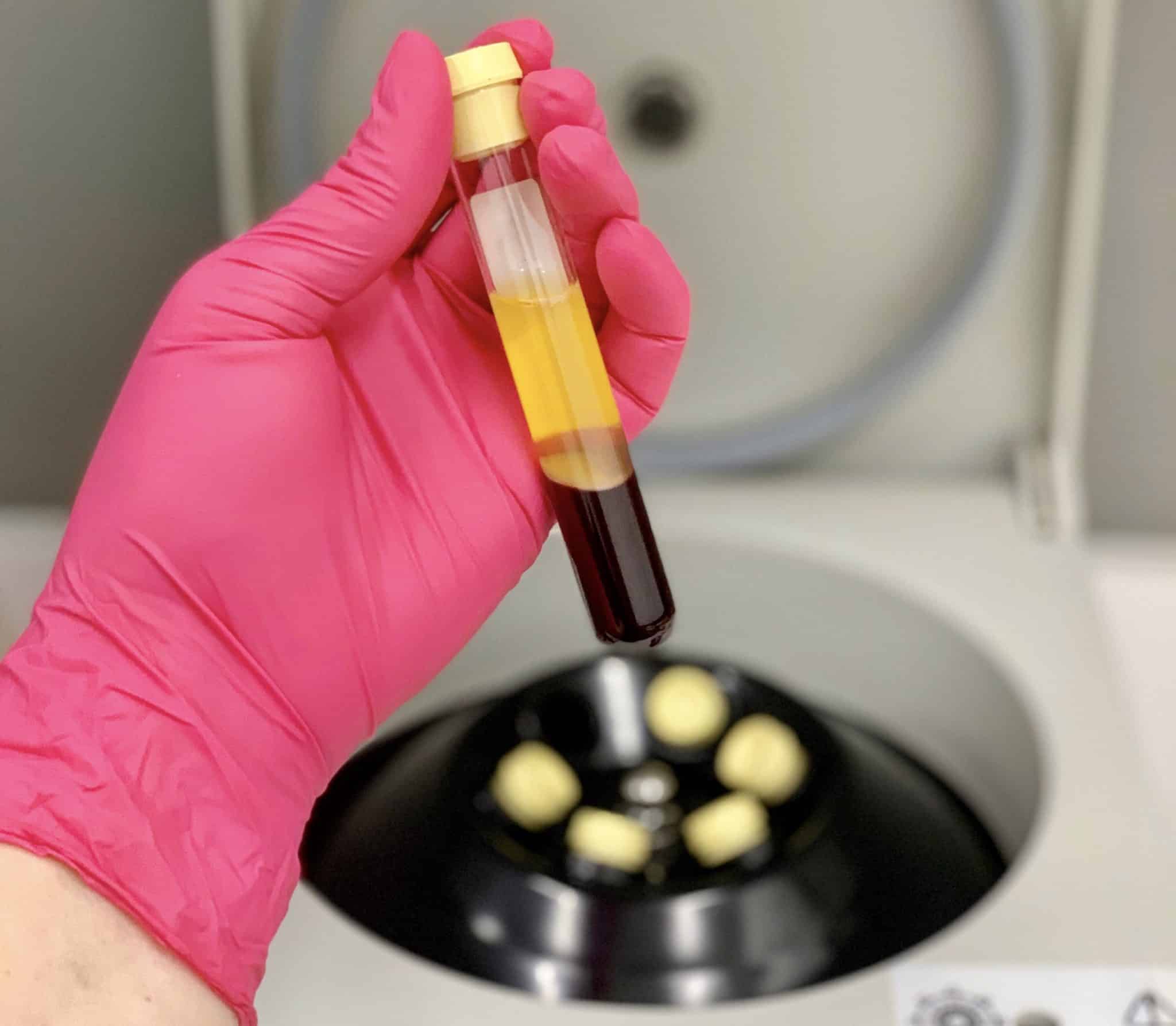 Platelet Rich Plasma (PRP)