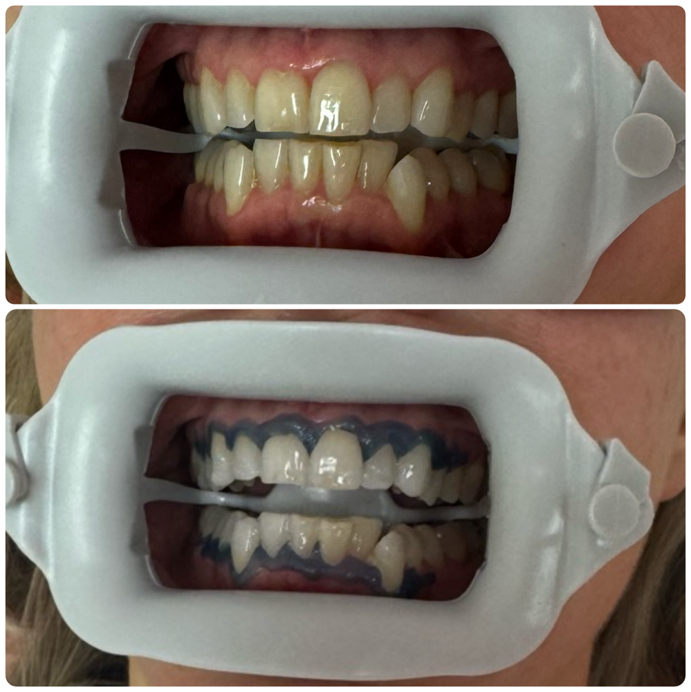 45 Min Teeth Whitening Session