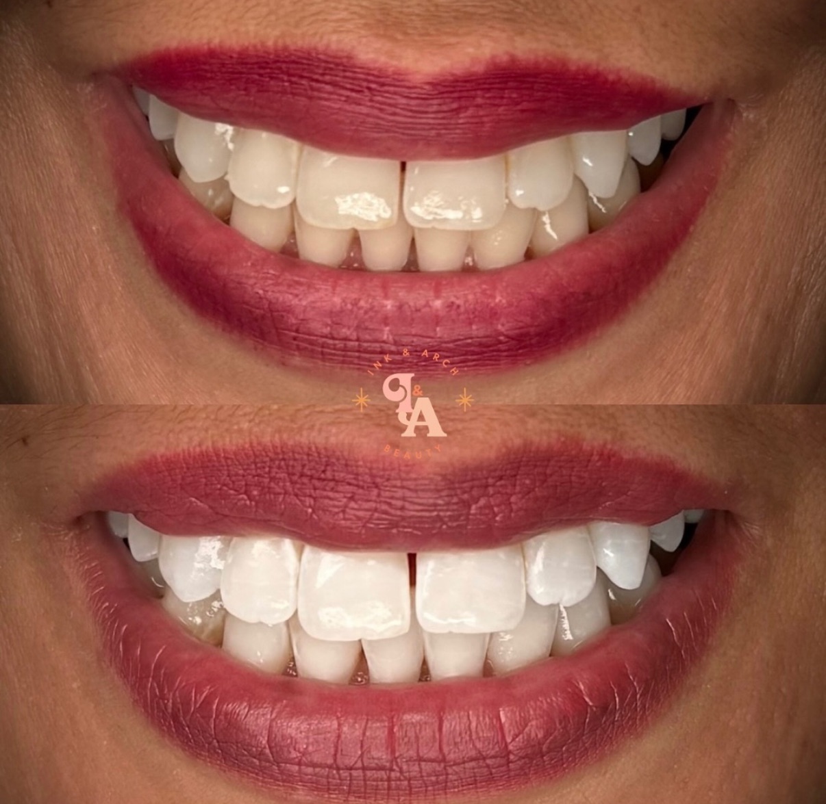 Teeth Whitening at Ink & Arch in San Diego, CA