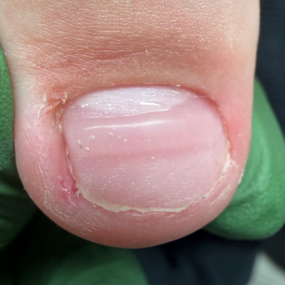 Toenail Brace at Divine Goddess | Wellness Nail Reconstructions in Spring Hill, FL