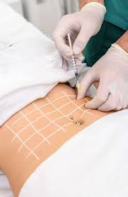 Lipo enzyme injections