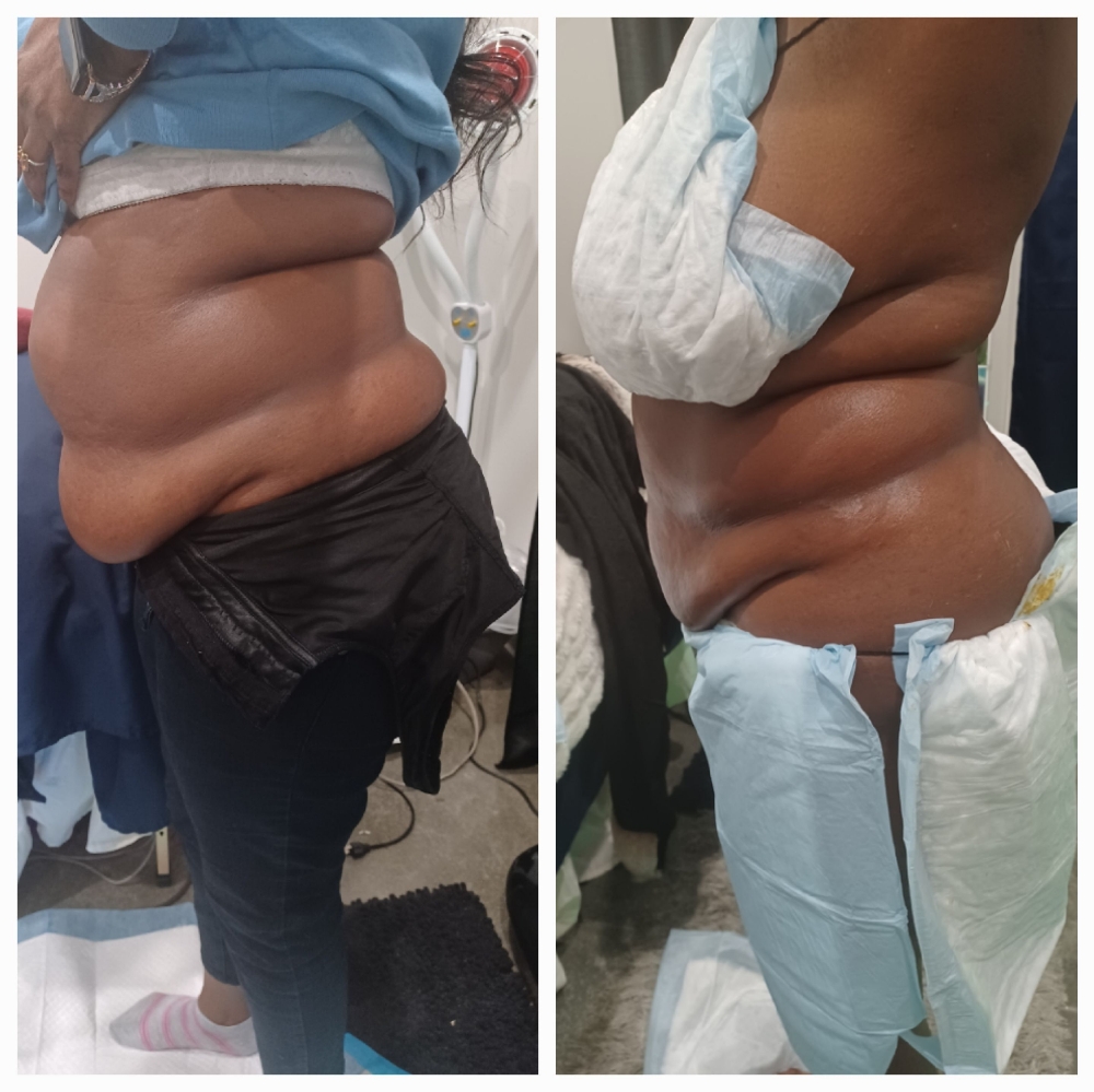 Single Treatment  Non-invasive Cavi