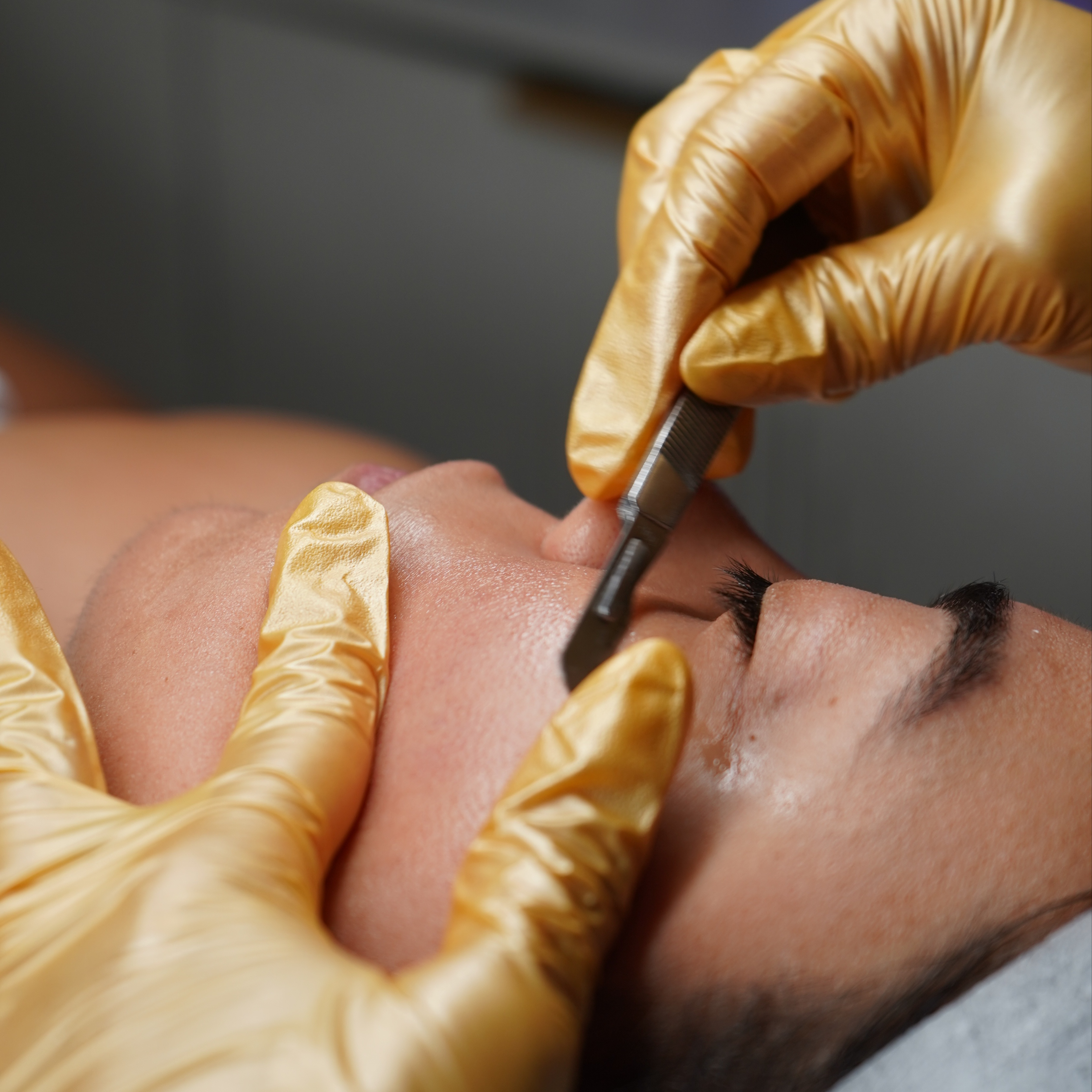 Dermaplane - ADD ON at Stephs A1 Beauty Bar in Southwest Ranches, FL