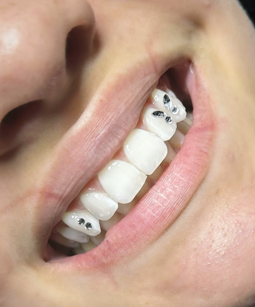 Custom Tooth Gem Design