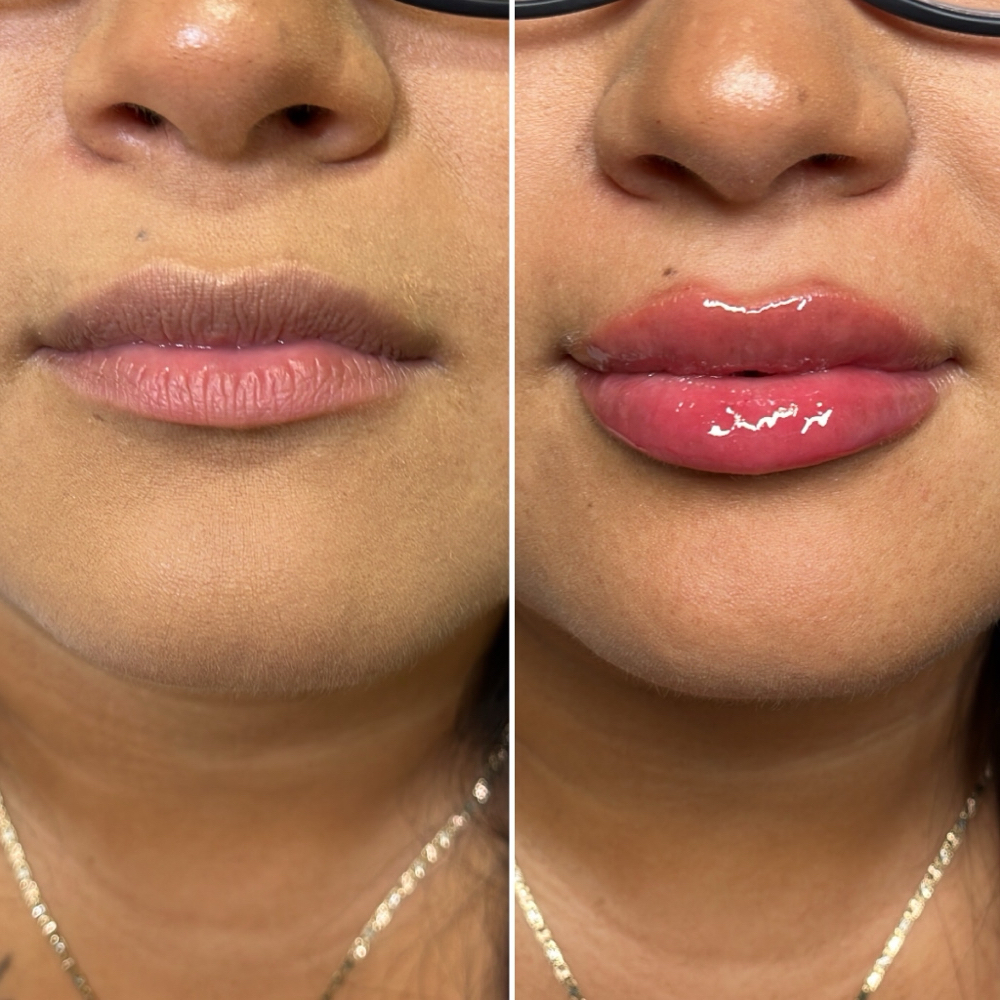 Juvederm Full Syringe Lip Filler