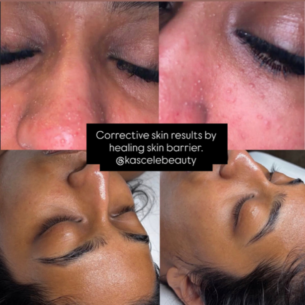 Clear Skin Facial at Kassandra Camacho in Port Jefferson, NY