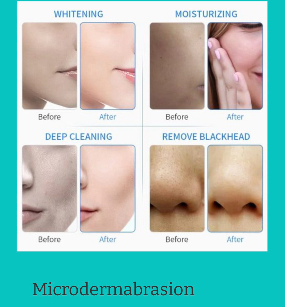 Microdermabrasion