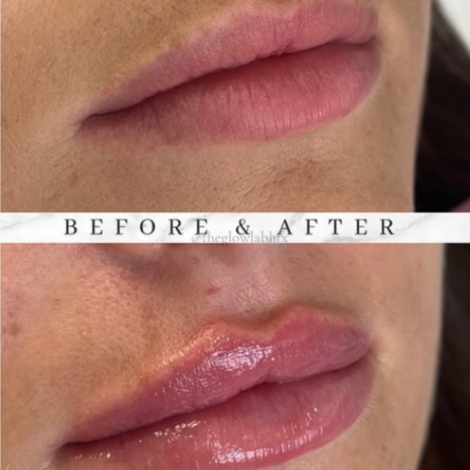 1/2 Syringe of Filler at Knight Aesthetics in Lawton, OK