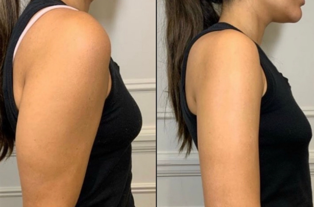 HIFU BRAZOS (ARMS) at Natural Glow in Grand Praire, TX