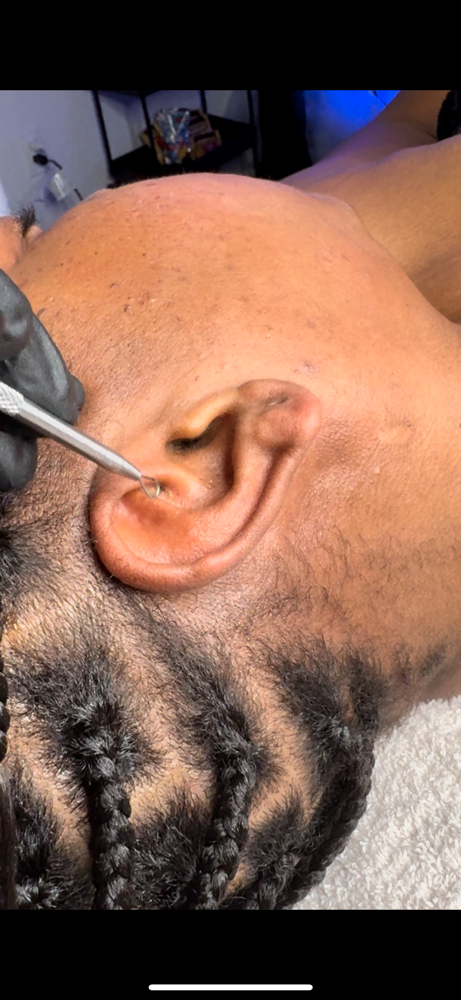 Ear Extractions