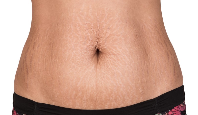 Stretch Mark Reduction Microneedle