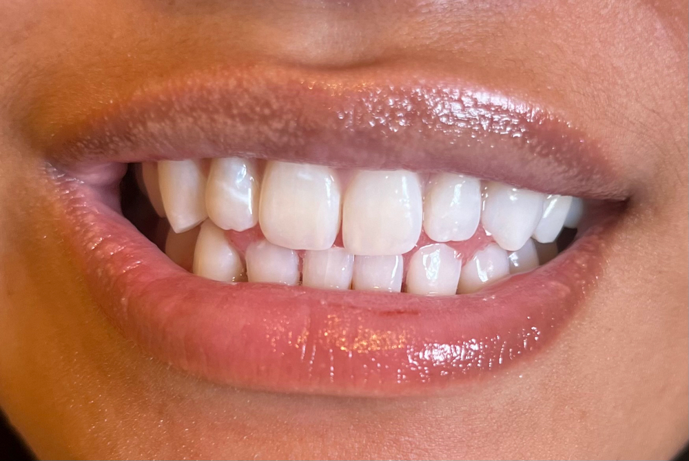 Yearly Teeth whitening touch up at Skin Promises in Las Vegas, NV