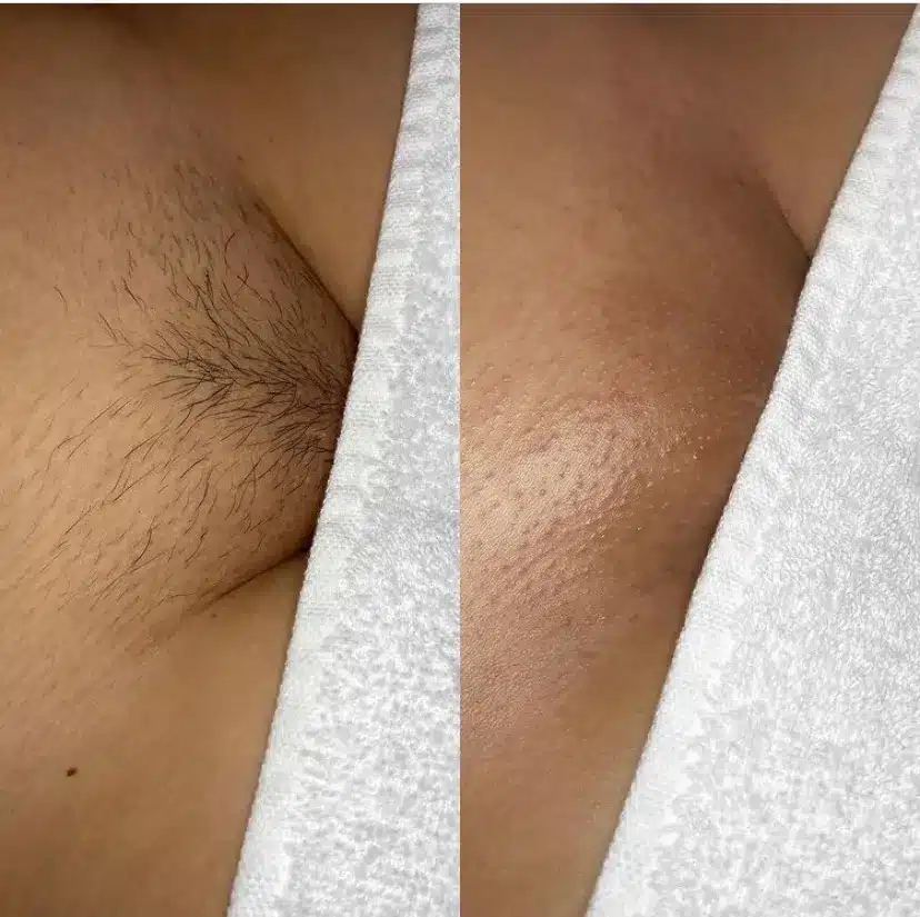 Brazillian Waxing