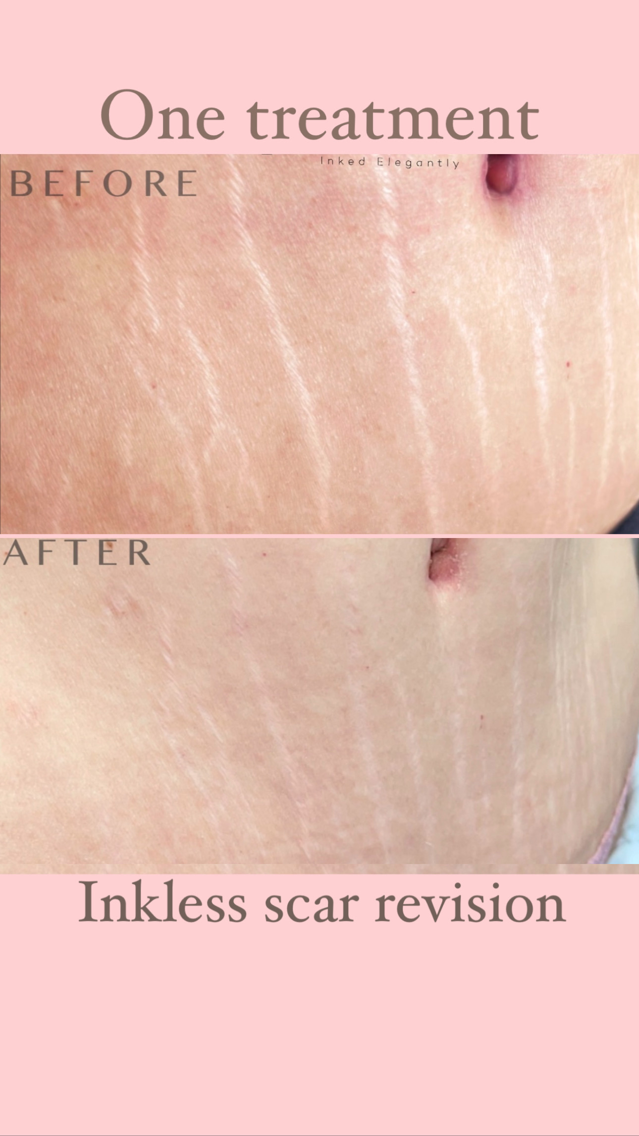 Inkless stretch, mark revision