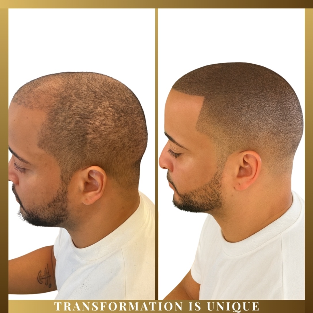 SMP Density (Hairline + Top Fill)