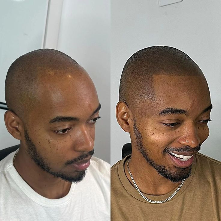 SMP Density (Hairline + Top Fill)