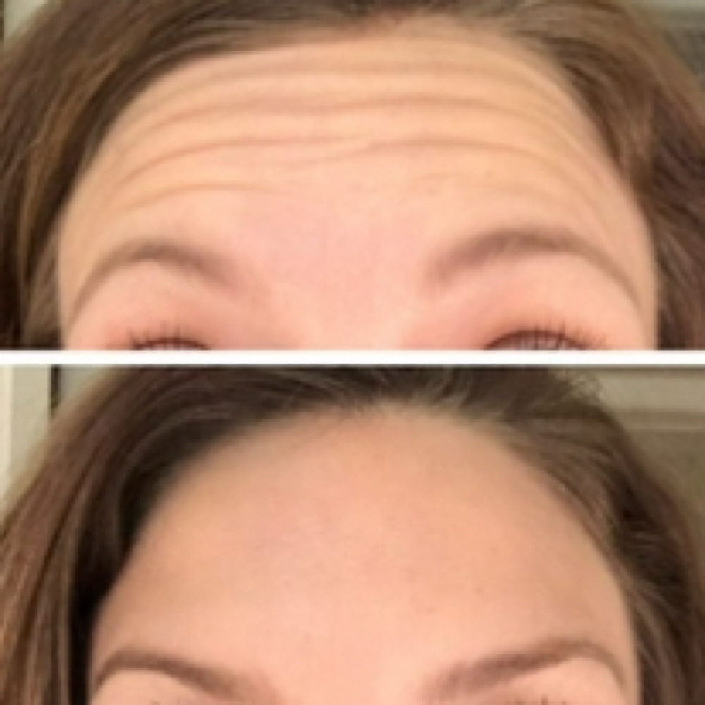 Botox Forehead & Glabellar Lines at Groomsology MedSpa in Mt Orab, OH