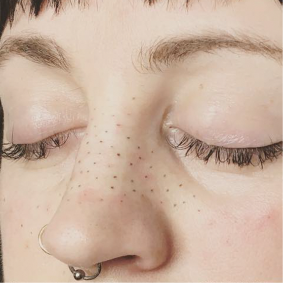 Freckles & Beauty Marks at Golden Kiss Aesthetics in Sewell, NJ