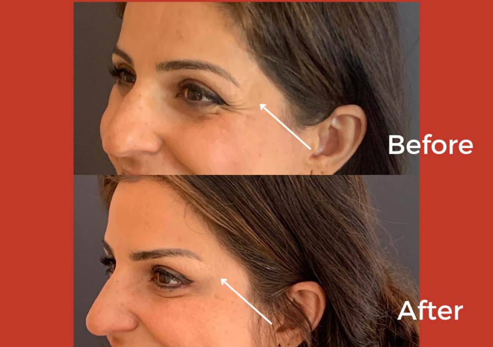 Brow Lift