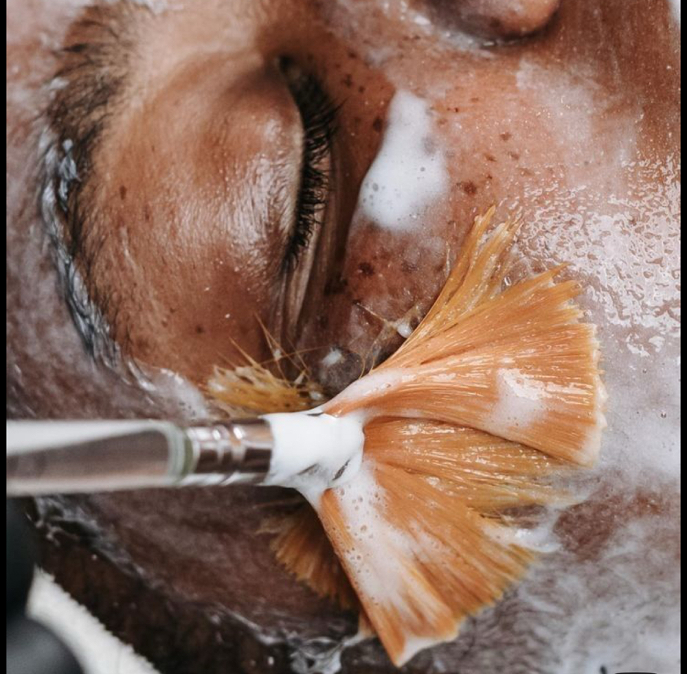 Microneedling