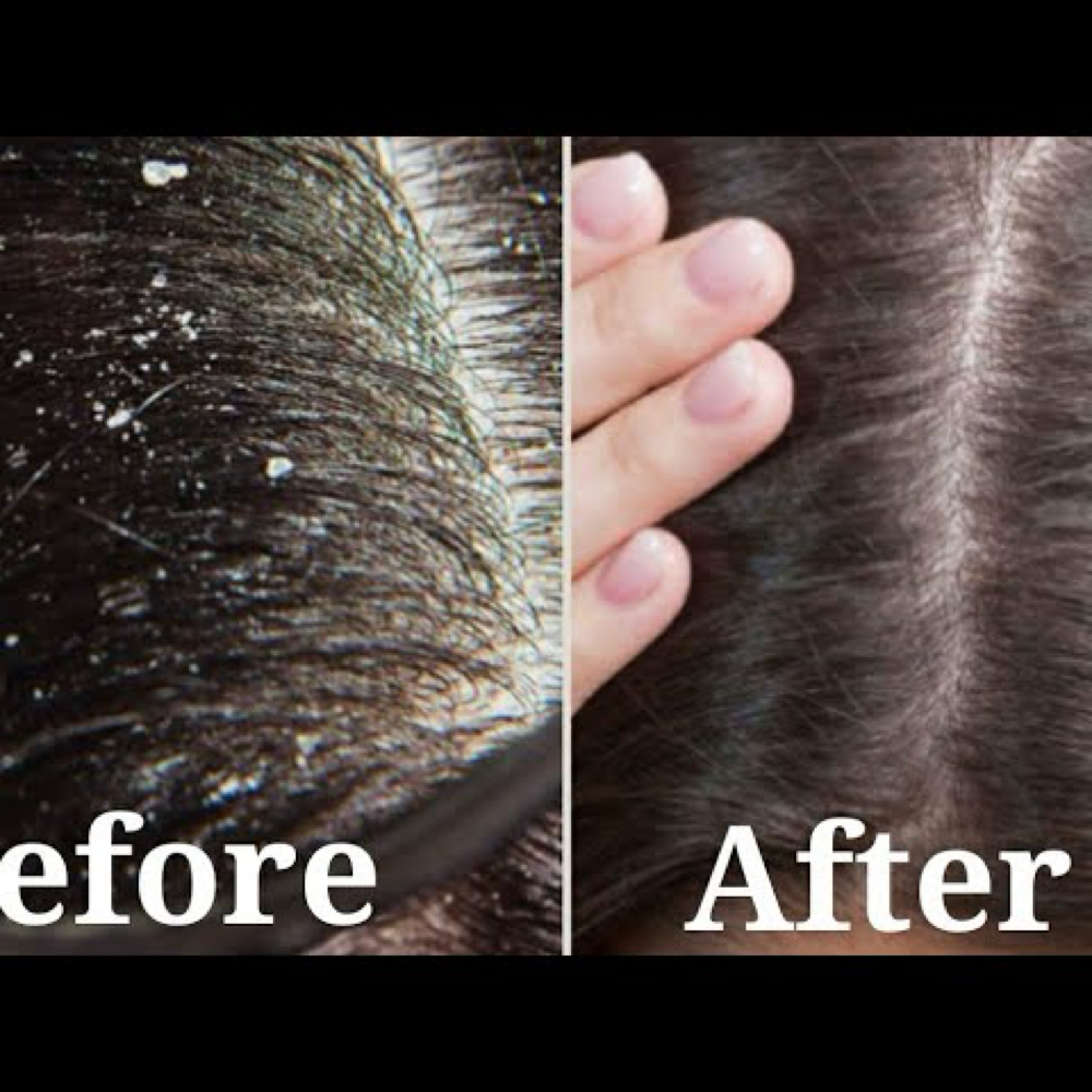 Hair Treatment - Dandruff Treatment at Kinu  Salon And Spa in New York, NY