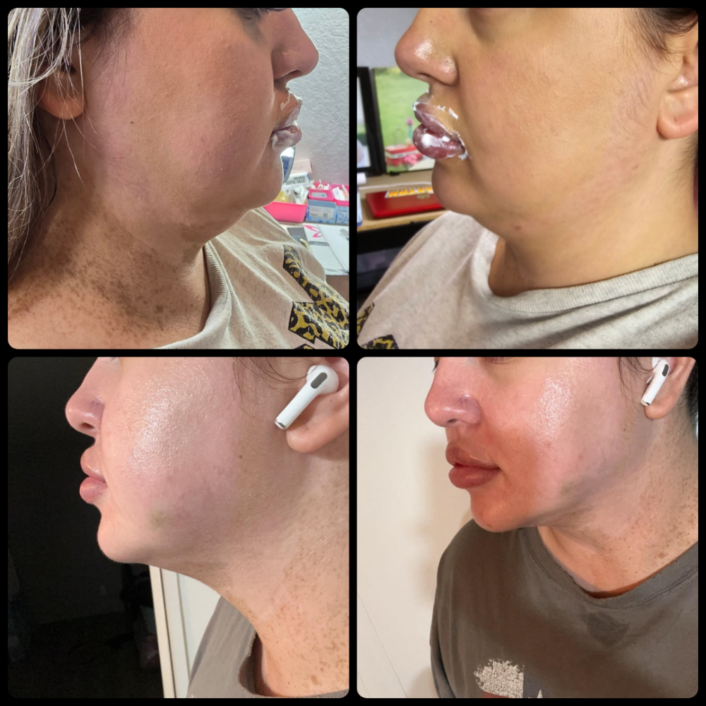 Jawline slimming