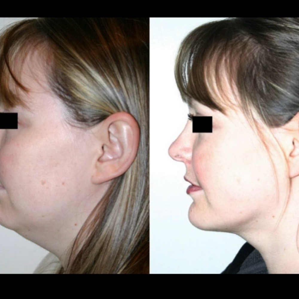 ✨ Add-On | Sculpted Chin RF at Tru U Esthetix in Franklin, TN