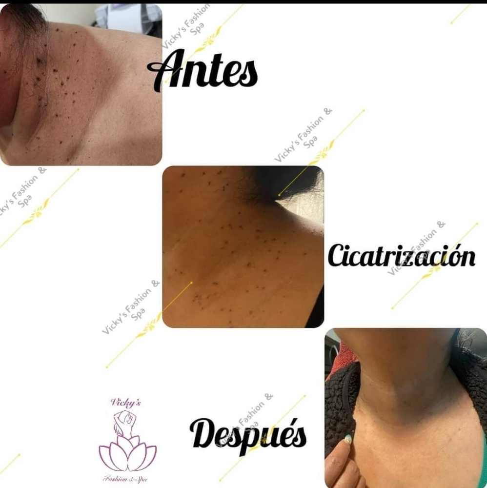 Cauterización De Verrugas