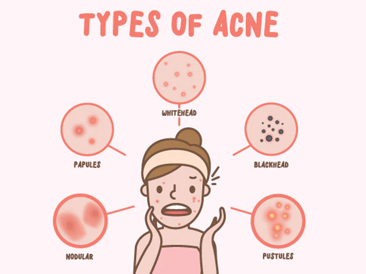 Acne and Pore Cleansing Facial