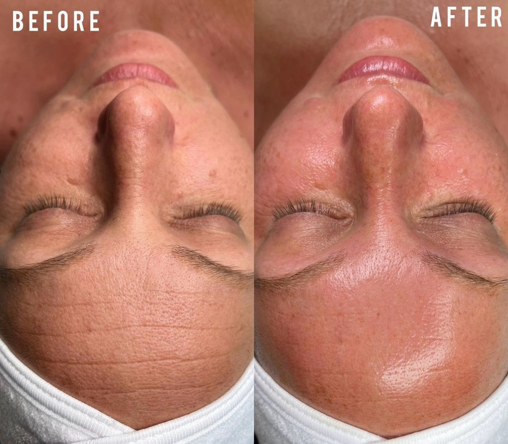 Hydrafacial + Dermaplane