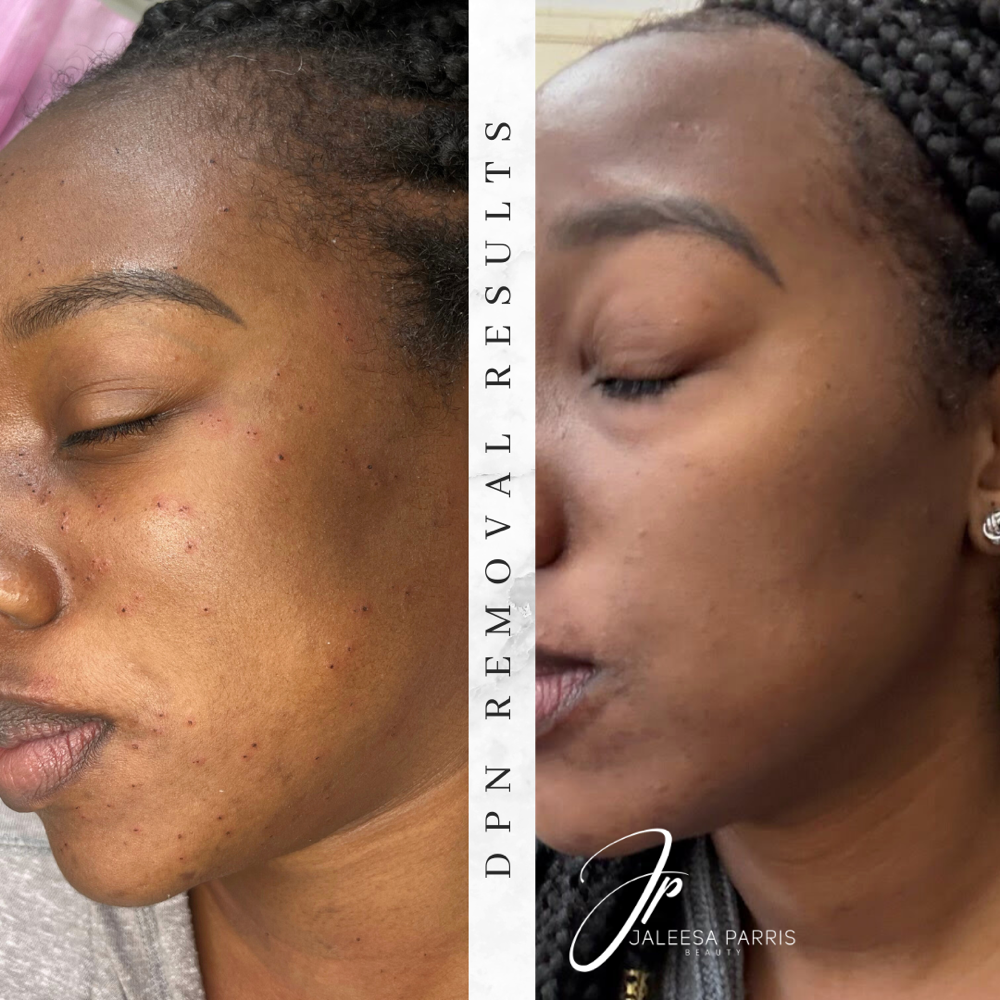 (2) DPN/ Skin Tag Bundle