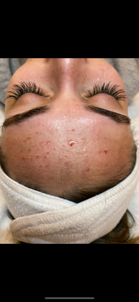 MICRONEEDLING