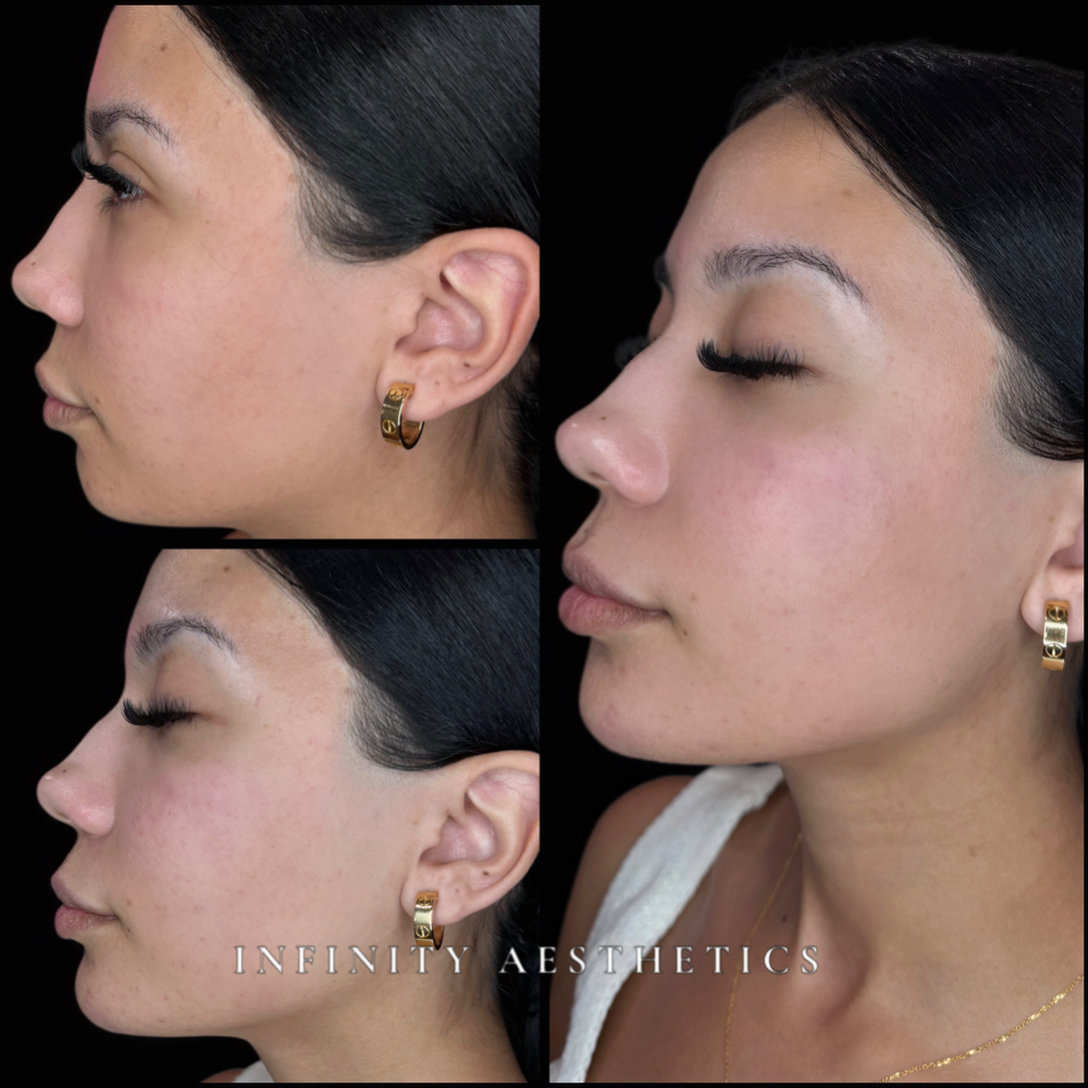 Profile Refresh at Infinity Aesthetics in Elsa, TX