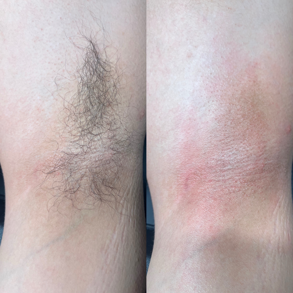 Underarm Wax