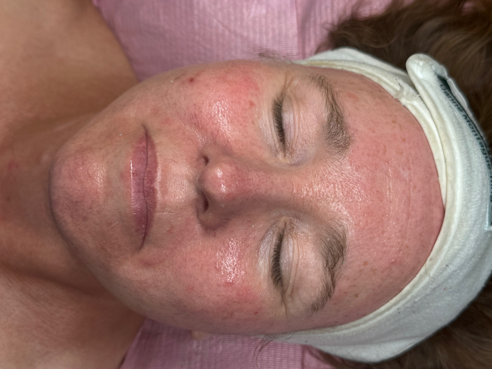 Blackhead+ Acne Extraction (ADD ON)