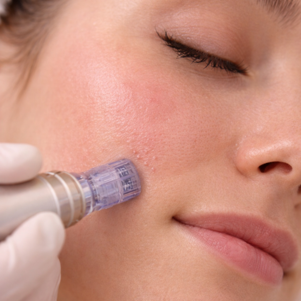 Microneedling at Sol & Skin Wellness in Duncanville, TX