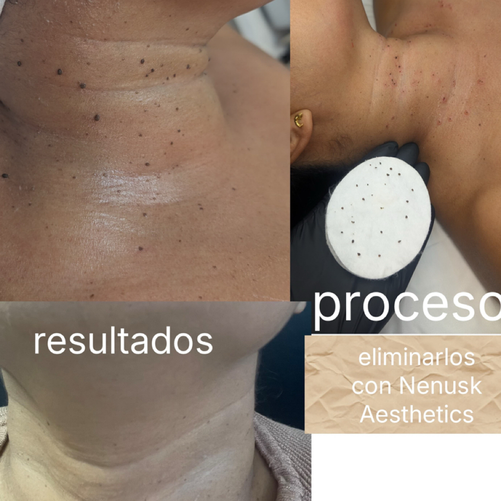 Removal of Skin Tags or Warts at Nenusk Aesthetics in Long Island City, NY
