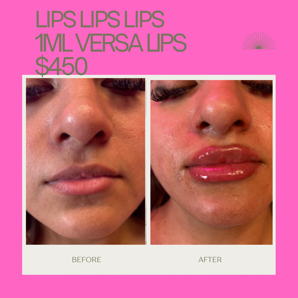 Lip Filler at Blush Beauty in Houston, TX