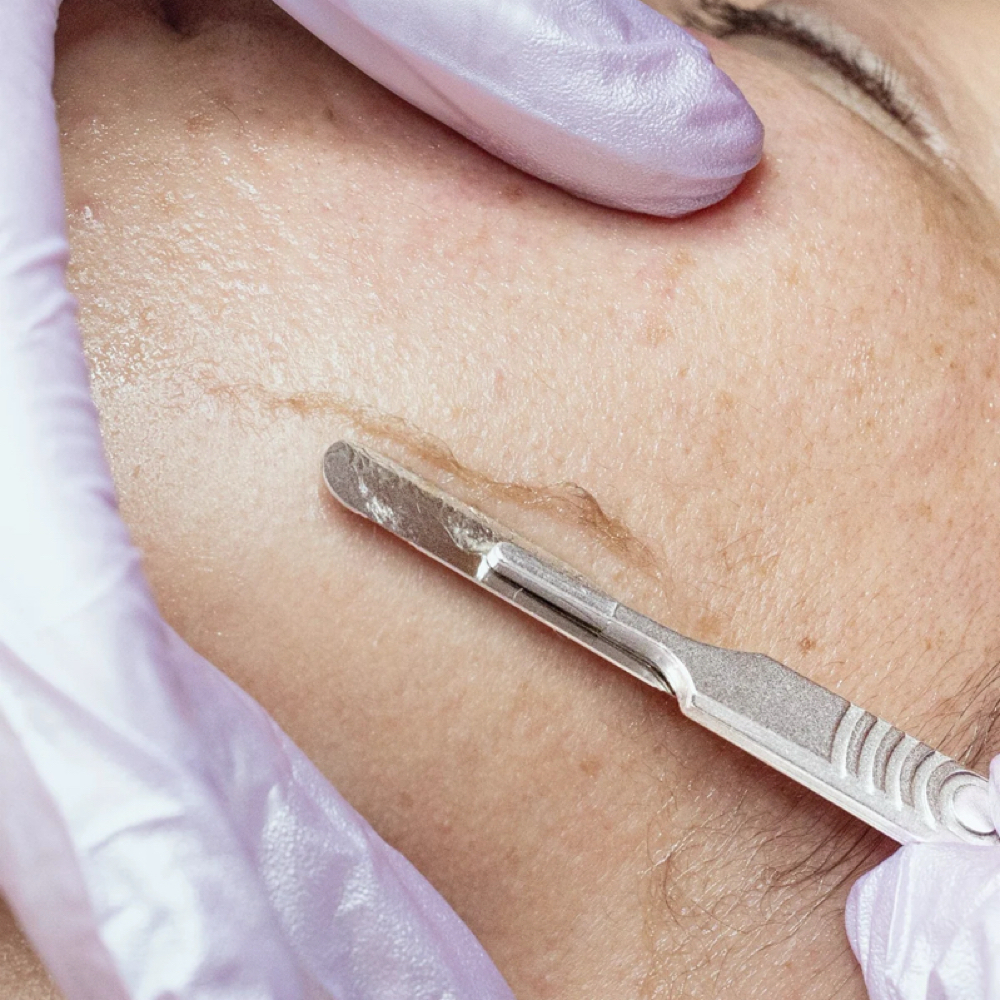 Dermaplane Add-On at Amanda Renee Esthetics in Marion, OH