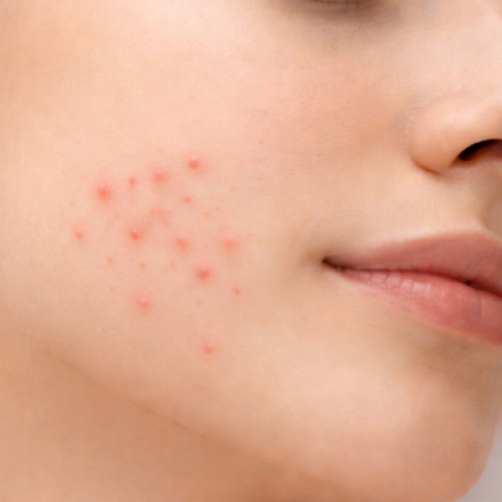 Acne Laser Spot Treatment