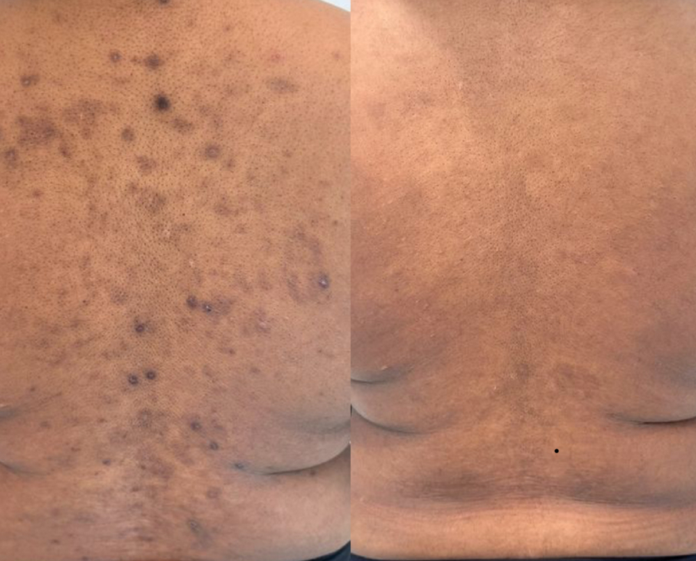 Body Chemical Peel