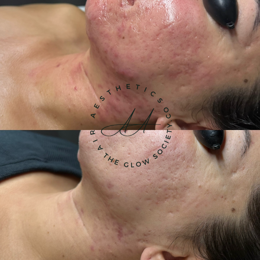 Glow Reset Facial – Acne & Barrier