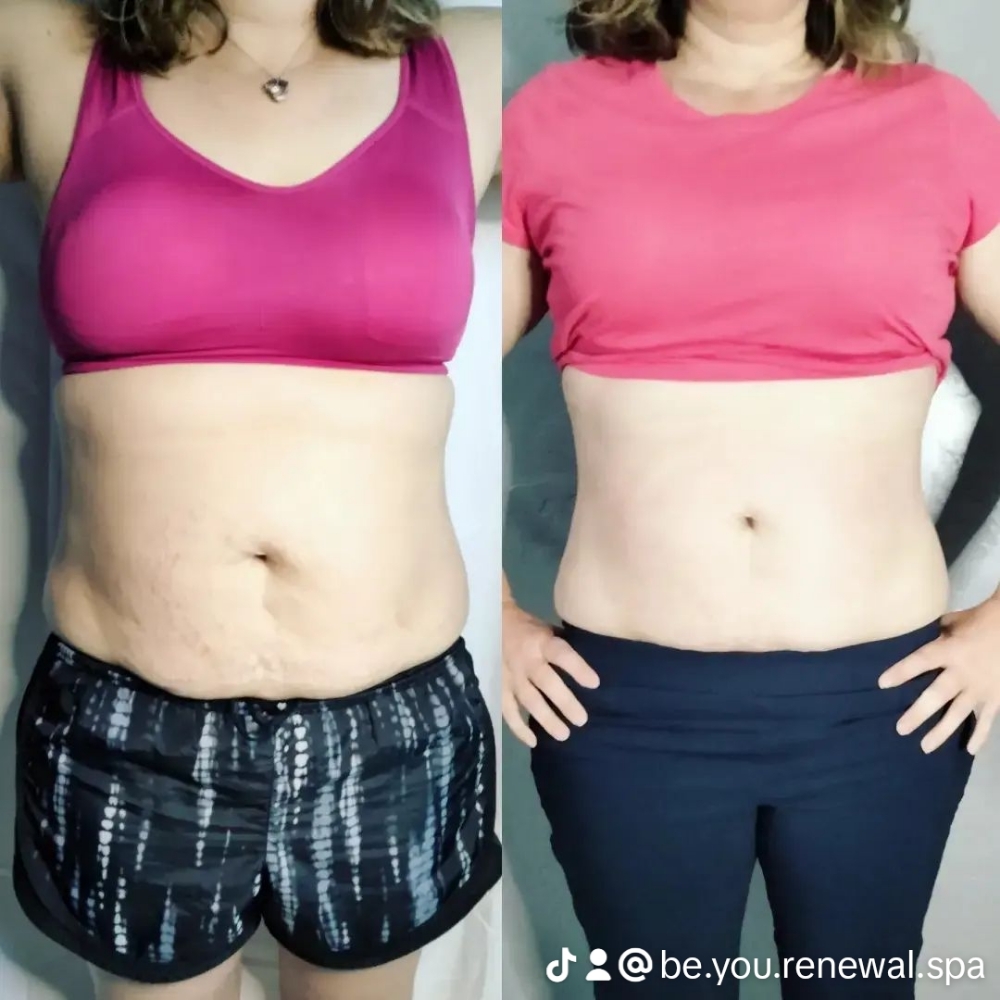 New Bod Renewal/Cavitation & RF